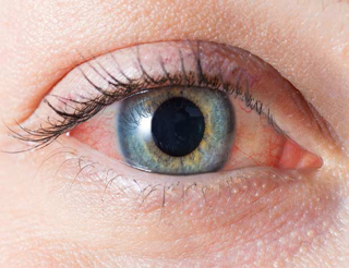 Glokom (Göz Tansiyonu) 