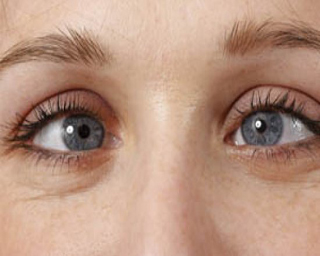 Şaşılık Ameliyatı